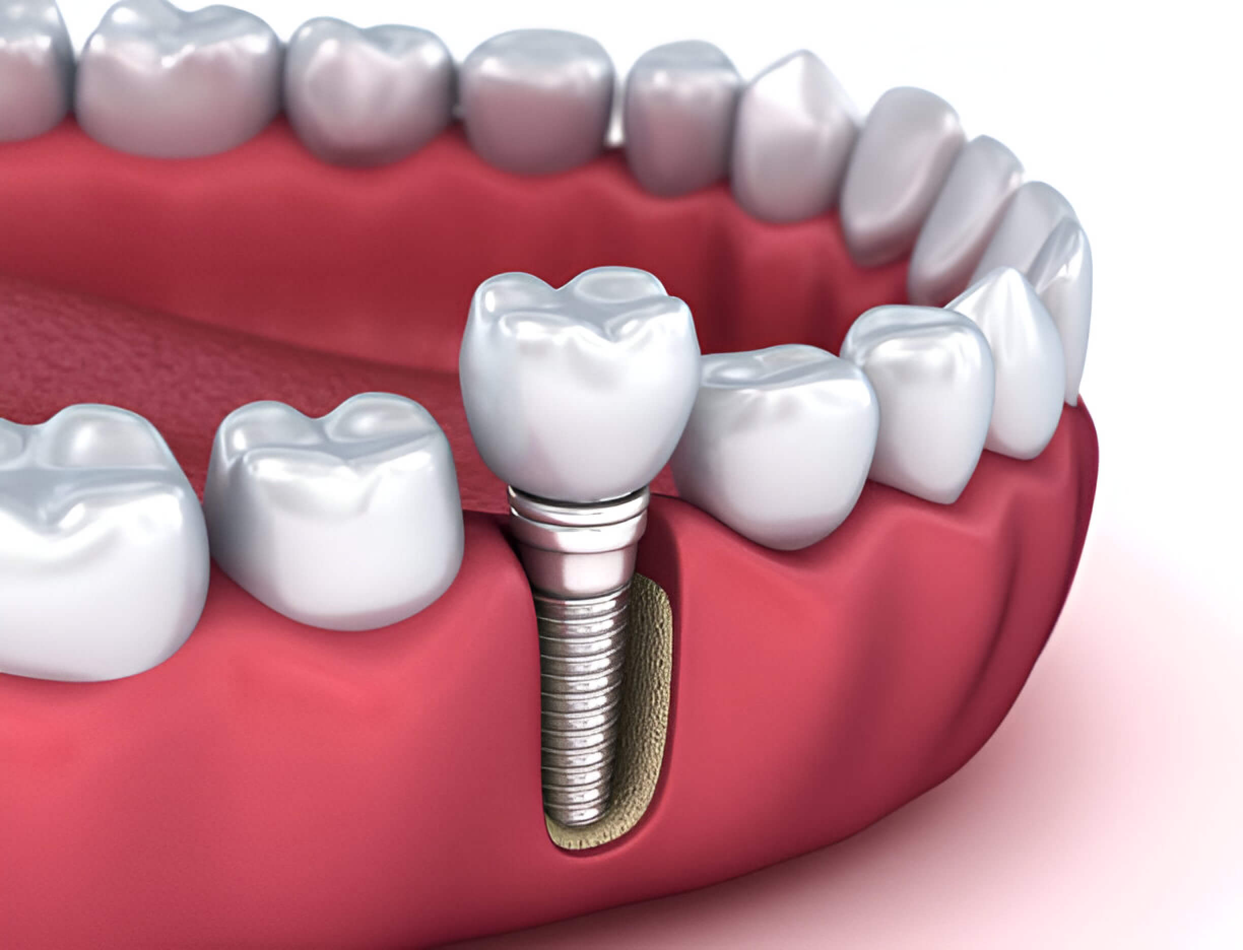 dental implants