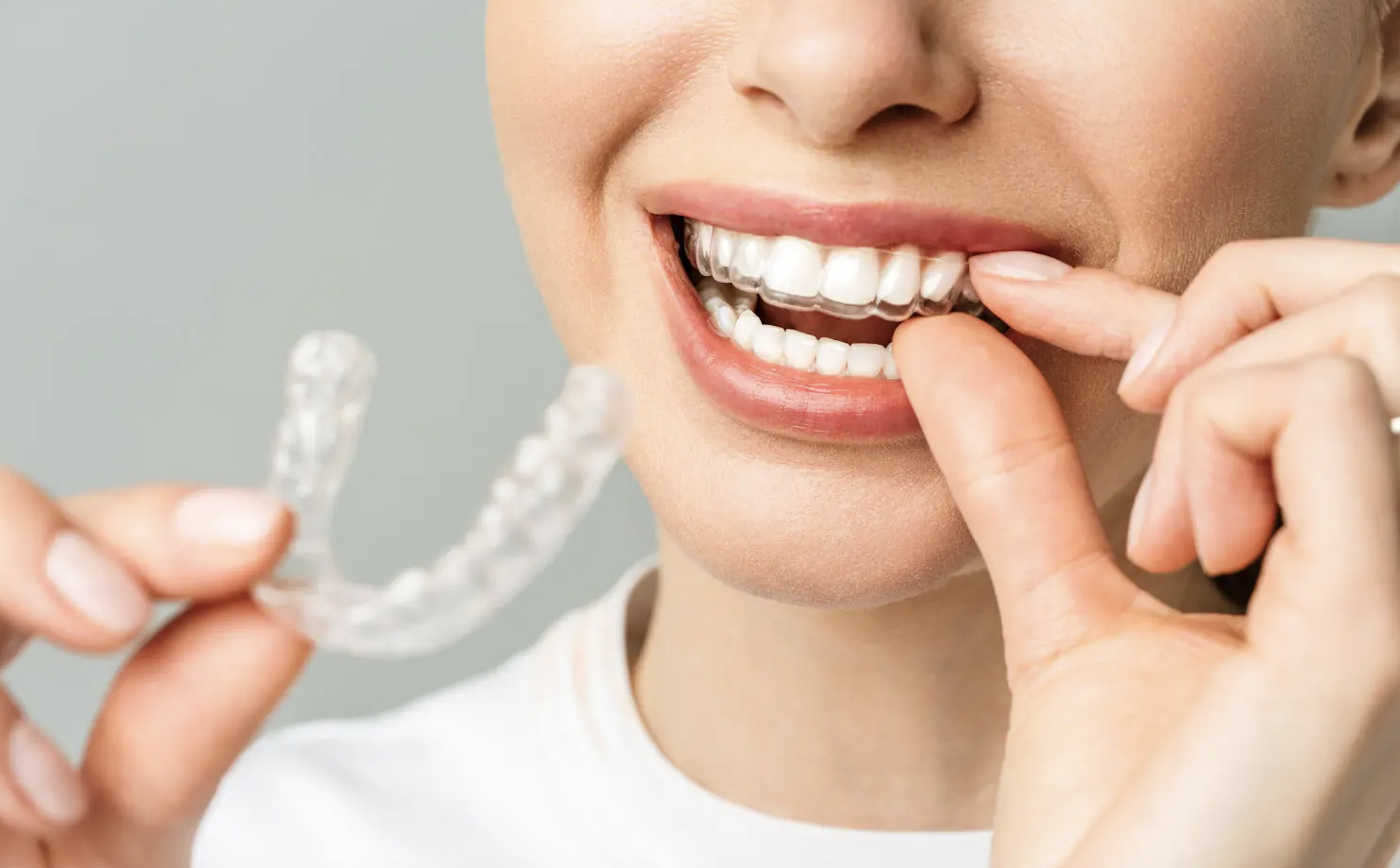 benefits of invisalign near you